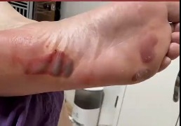 上海一女子踩指压板20分钟脚底喷血 网上流行的别盲目跟风！